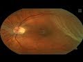 Retinal Detachment or Not?