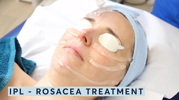 How to treat rosacea? - IPL