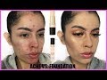 ACNE VS FOUNDATION: MILANI CONCEAL + PERFECT FOUNDATION STICK & CONCEALER | Rocio Ceja