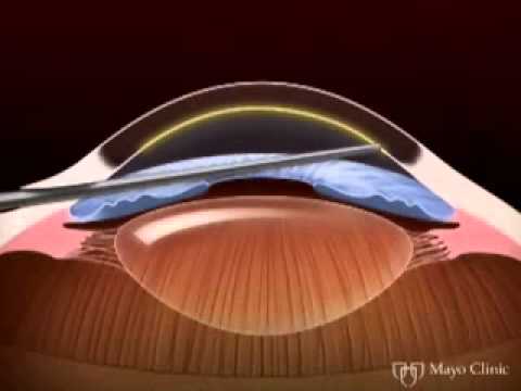 თვალის რქოვანას გადანერგვა