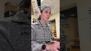 Do You Have These Red Bruises On Your Arms Could Be Actinic Purpura dermatologist shorts