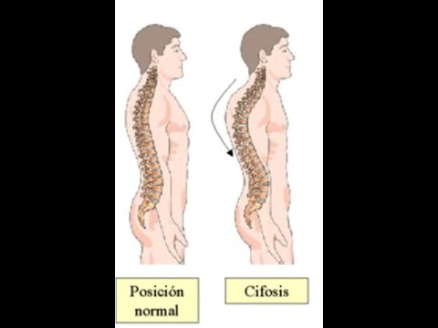 Ejercicios para mejorar la postura de la espalda joroba