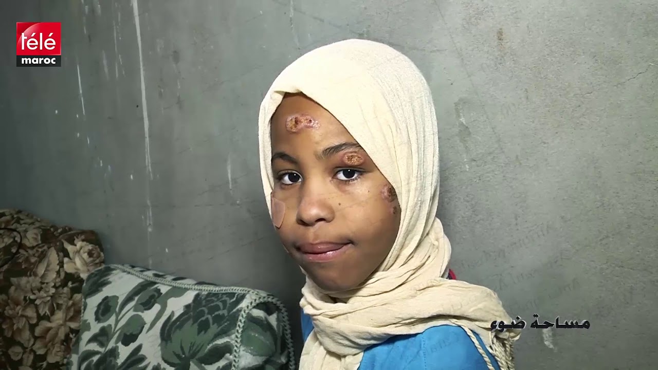 داء الليشمانيا يشوه أجيال الغد..قصص مؤثرة من جنوب المغرب
