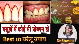मसूड़ों में सूजन दर्द का इलाज|dant k masude fulne ka gharelu upay|Gum swelling,gingivitis t/t @ home