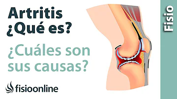 ¿Cómo sé qué tipo de artritis tengo?