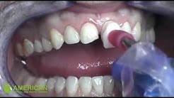 Veneers Treatment In Dubai By American Medical & Dental Center