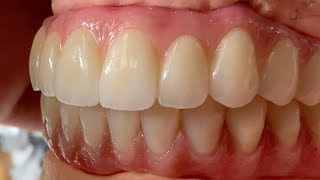 Process of Fabricating Full Mouth Implant Restorations