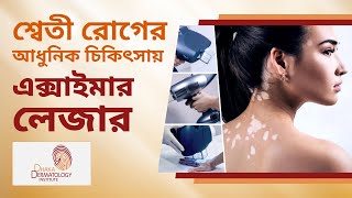 শ্বেতী রোগের চিকিৎসা । শ্বেতী রোগের চিকিৎসায় এক্সাইমার লেজার ব্যবহারের উপকারিতা