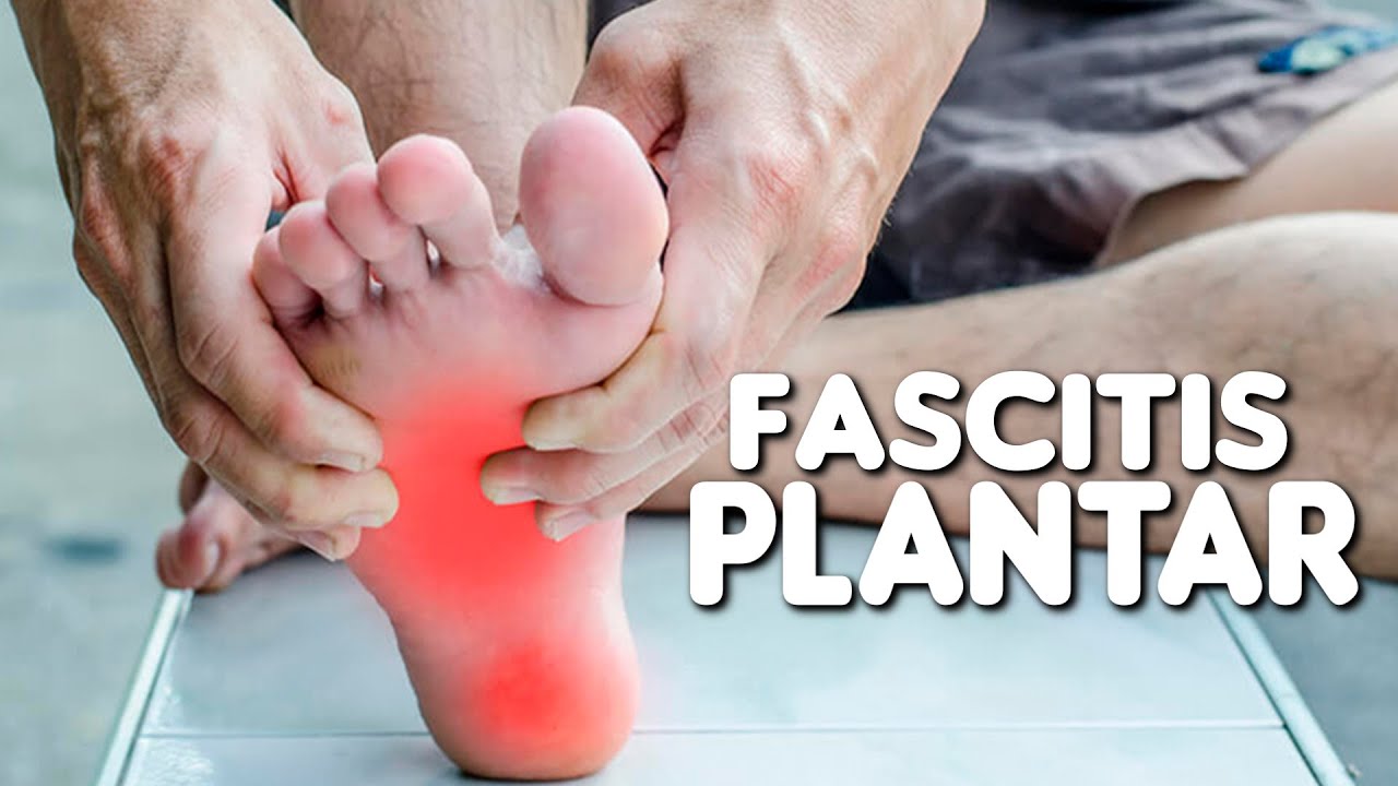 FASCITIS PLANTAR Que es, causas y tratamiento YouTube