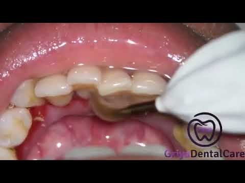 Video: Curățarea Cu Ultrasunete A Dinților
