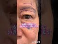 目周り複合で若返り👀💫#眉下リフト #眉下切開 #アンチエイジング