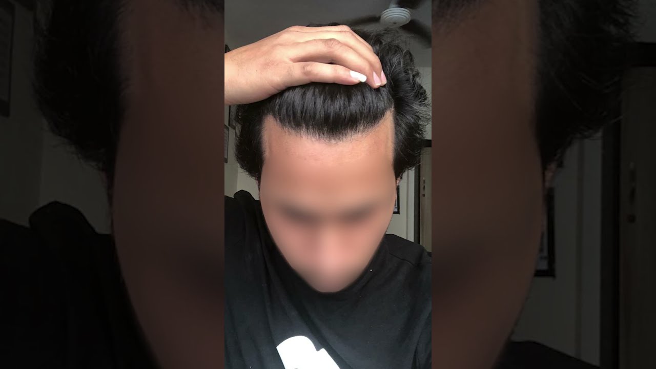 Transforming Hair Lives Witness The Amazing Results Of Our Transplant Procedure