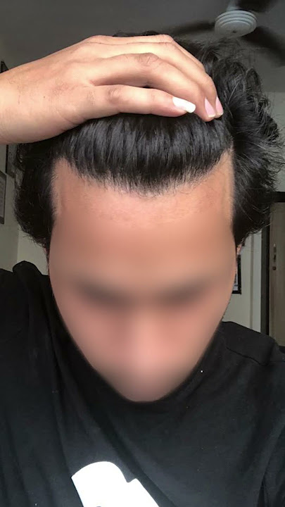 Transforming Hair, Transforming Lives! Witness the amazing results of our hair transplant procedure