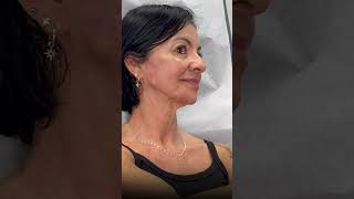 Rearmonização facial nas bochechas com preenchimento de ácido hialurônico.