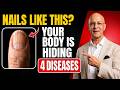 Neurologist Warns: If Your NAILS Look Like THIS After 60, Your Body May be Hiding 4 Diseases|Mandell