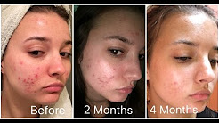 Retin-A 4 Month Skin Update (Acne) | jennybeYOUty