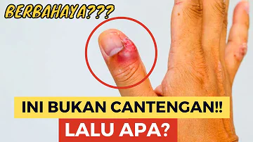 PARONIKIA INFEKSI KULIT PADA KUKU TANGAN/KAKI=CANTENGAN?? (KUPAS TUNTAS)