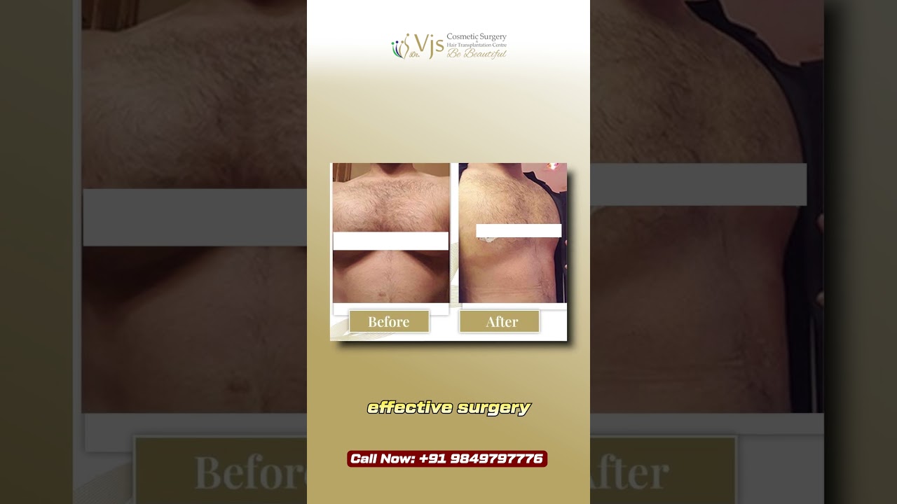 Confidence starts with the right care—Gynecomastia surgery cost in Vizag  at VJ’s Clinics.