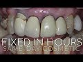 Amazing Smile Transformations and Makeovers -  Cosmetic Veneers, Invisalign, and Dental Implants