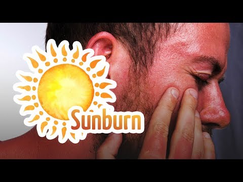 Video: 3 Cara Mudah untuk Menutupi Sunburn