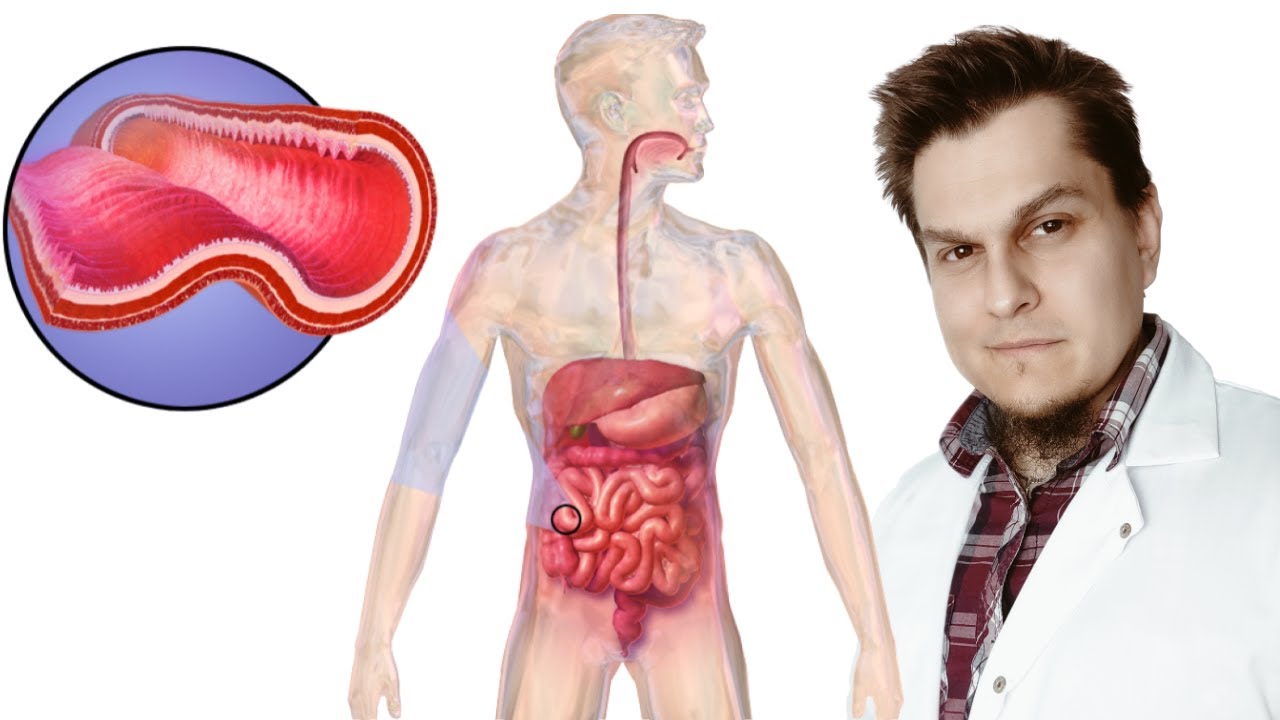 Zapalenie jelit - Oznaki, których nie możesz ignorować ! Dietetyk kliniczny Michał Strużyk