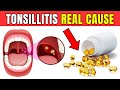 This is the REAL CAUSE of your recurring TONSILLITIS - it&#39;s not what you think!