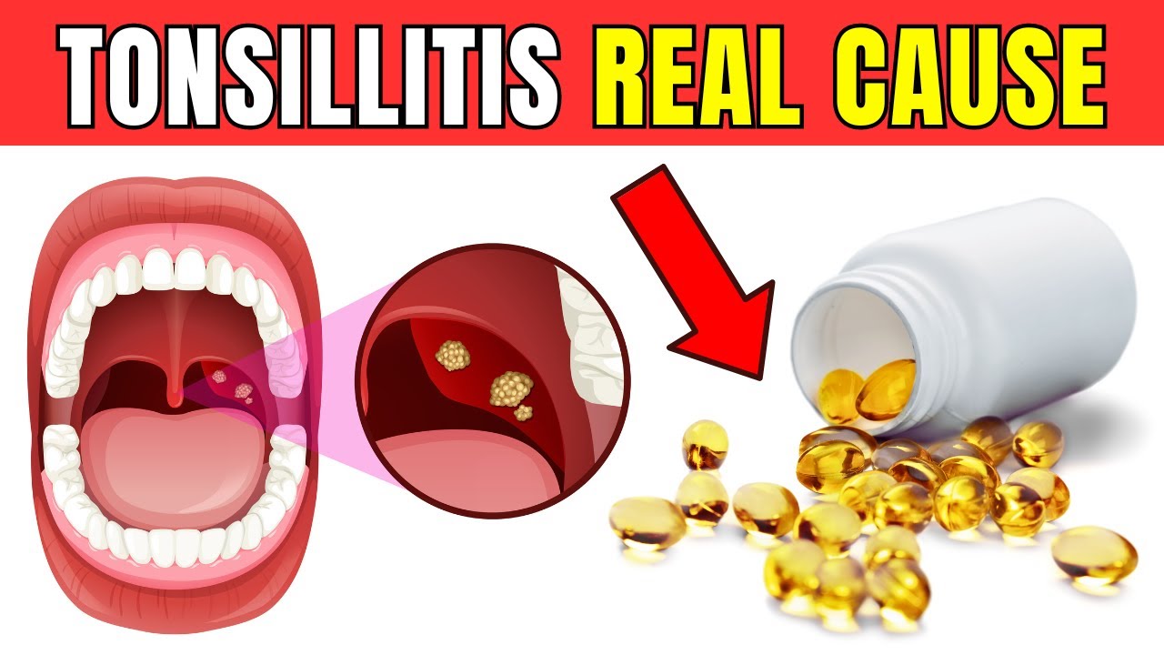 This is the REAL CAUSE of your recurring TONSILLITIS - it's not what you think!