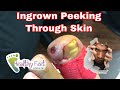 Worst Ingrown of the Year, Ingrown Toenail, Infected Ingrown Nail , Ingrown Toenail Removal