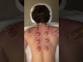 What is cupping?