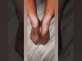 त्वचा में सफ़ेद दाग क्यू हुआ? #vitiligo #pigmentation #sideeffects #shortvideo #shortsfeed #shorts