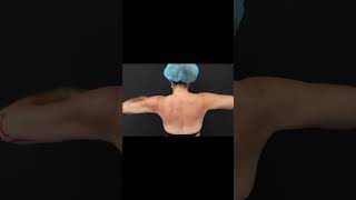 Celebrity Arms™ Liposuction | Immediate Results | Expert Dr. Thomas Su | Artlipo