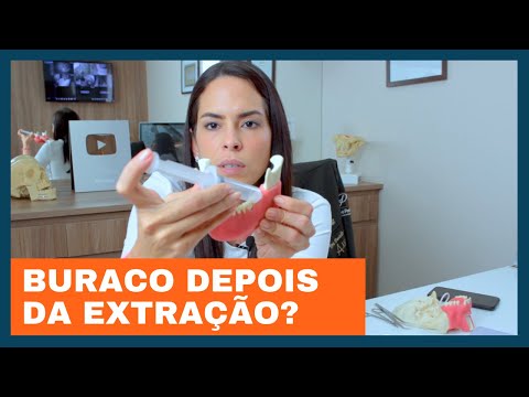 Vídeo: Como limpar os dentes após a remoção dos dentes do siso (com fotos)