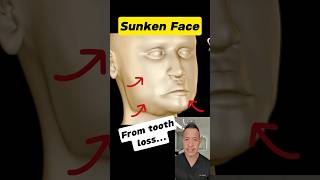 Tooth Loss & Facial Collapse: The Shocking Connection #dentallan #dentist #shorts News
