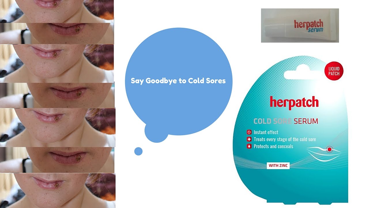 Got a Cold sore? | Herpatch Review | Prevent Cold Sores - YouTube