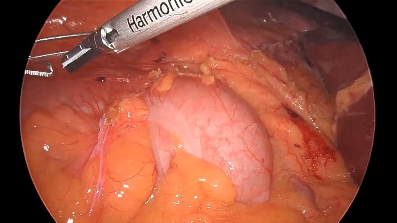 Laparoscopic right simple nephrectomy