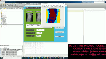 Detection of Rheumatoid arthritis using Image processing
