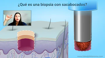 ¿Qué ocurre si la biopsia da positivo para melanoma?