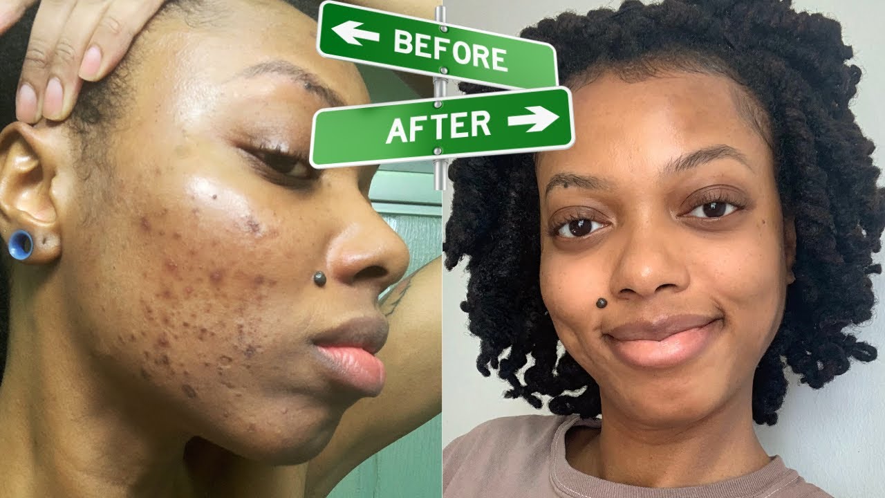 How I Got Rid Of My ACNE & HYPERPIGMENTATION - YouTube