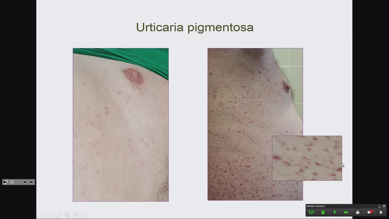 Sérová Tryptáza Jako Jedno Z Diagnostických Kritérií Mastocytózy Youtube 