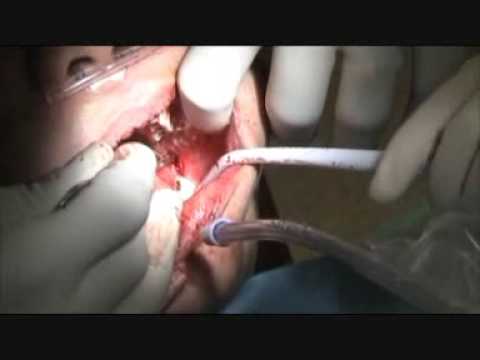 Dental Implants Bone Grafting Procedure - Part 1