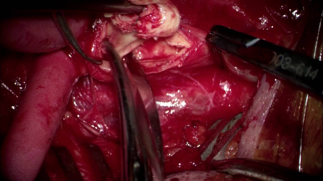 Right Carotid Endarterectomy for Carotid Stenosis
