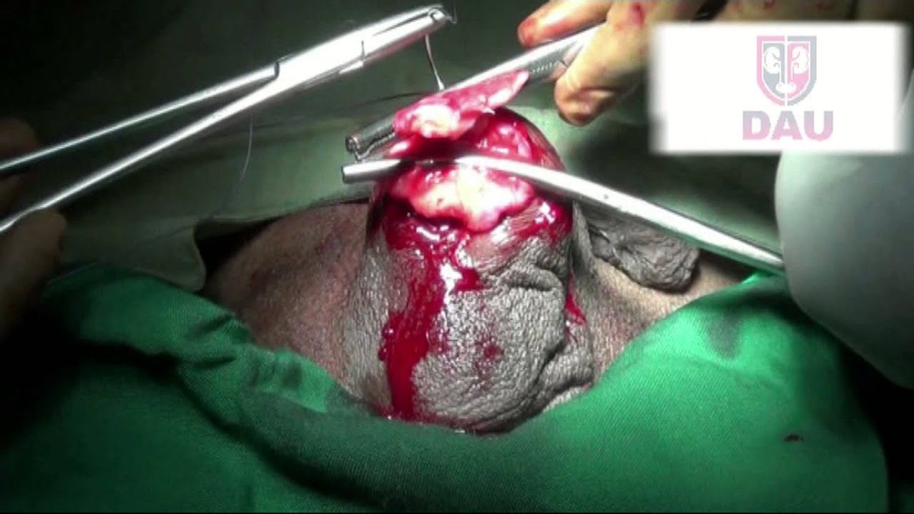 video phone beyonce mp3 Total Orchiectomy final