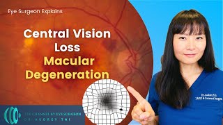 Macular Degeneration Everything You Need to Know | Eye Surgeon Explains #draudreytai