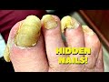 THICK Diabetic Nails And Callus Trimming