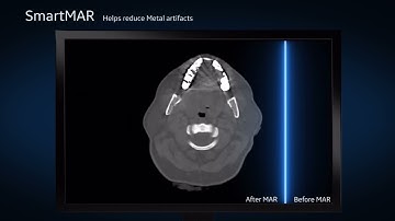 GE Revolution Aspire CT Machine - Product video