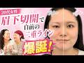 【23歳 奥二重】目周りスッキリ、写真撮影いつでもOK💖加工なしで理想の目元に👁️✨【眉下リフト＋脂肪切除】