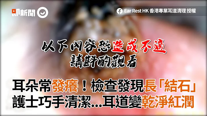 耳朵常發癢檢查發現長「結石」 護士巧手清潔耳道變乾淨紅潤｜耳結石｜清耳垢 - 天天要聞