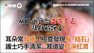 耳朵常發癢檢查發現長「結石」 護士巧手清潔耳道變乾淨紅潤｜耳結石｜清耳垢