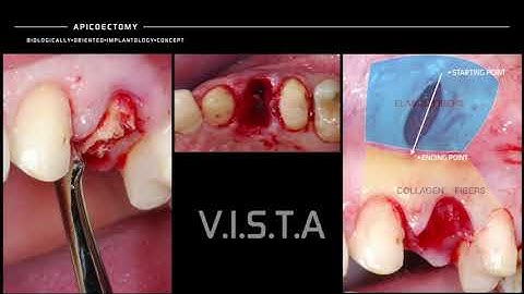 V.I.S.T.A TECHNIQUE FOR MINIMALLY INVASIVE SURGERY