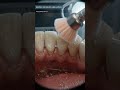 Full Mouth Deep Cleaning 😱 Heavy Plaque & Bacteria Removed!